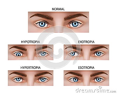 Different types of strabismus. Cartoon Illustration
